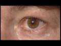 Cataracts