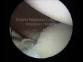 Arthroscopic Bankart Labral Repair
