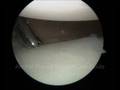 Arthroscopic Bankart Labral Repair
