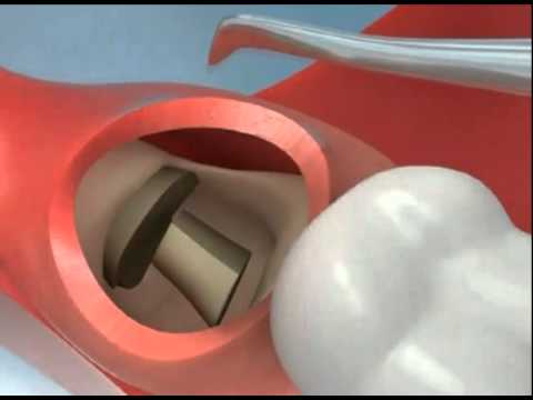 how to care wisdom tooth extraction