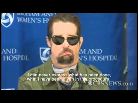 Nation's first face transplant Nation's first face transplant