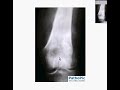 Pathology - Osteosarcoma of bone