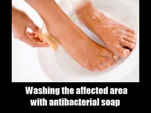 how to cure ingrown toenail