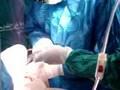 Maxillofacial Surgery: mutiple Implant placement