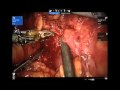 Robotic-Assisted Partial Nephrectomy In Case Of Single Kidney Robotic-Assisted Partial Nephrectomy In Case Of Single Kidney