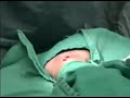 Ankle Screw removal S.S.I.N. Edmonton Ankle Screw removal S.S.I.N. Edmonton