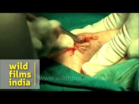 how to drain breast cyst