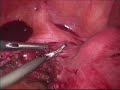 LSH with Pedunculated fibroid.mp4