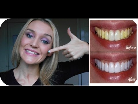 how to whiten teeth that have no enamel