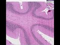 Histopathology Brain--Adrenoleukodystrophy