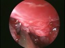 Maxillary Sinus Pyocoele Maxillary Sinus Pyocoele