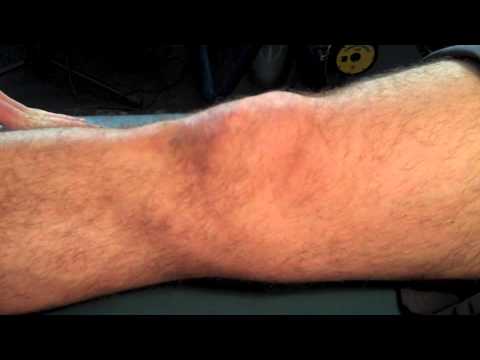 how to drain suprapatellar effusion