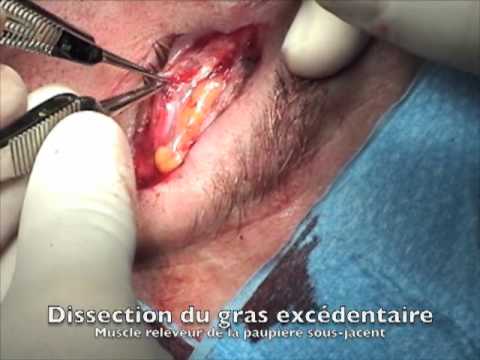 traitement poches yeux - http://www.CliniqueO.com Blépharoplastie supérieure à la Clinique O, chirurgie plastique et esthétique de l'oeil, à Montréal par Dr Patrick Boulos. Traitemen...