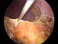 Trattamento laparoscopico di surrenectomia - Prof. Dr. Mario Falsaperla