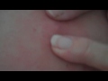 The Zit That Won