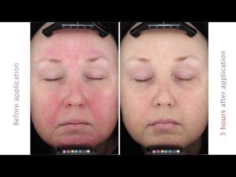 how to cure rosacea