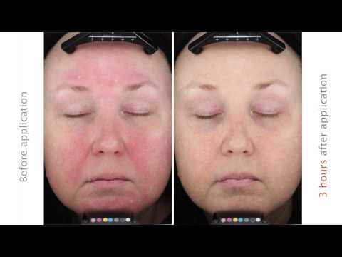 how to treat rosacea