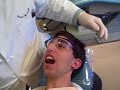 Braces off - removing Alec\