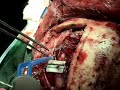 CRANEOTOMIA PARA MENINGIOMA CEREBRAL