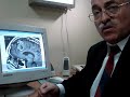 CRANEOTOMIA PARA MENINGIOMA CEREBRAL