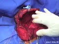 Total Scapula Prosthesis Ewing\