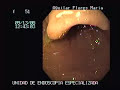 erosive gastritis