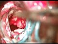 TUMOR INTRAVENTRICULAR (DR. MATUTES) TUMOR INTRAVENTRICULAR (DR. MATUTES)