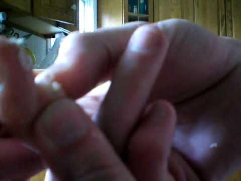 gross - Back in in 1997, when i was 12 years old, i first noticed a lump growing on the outside of my middle finger. Unlike most people I use my ring and middle fing...