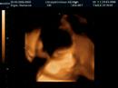 3D Ultrasound of Jacob - 7