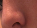 Blackhead forest!