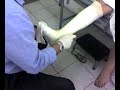 ESGUINCE DE TOBILLO GRADO II