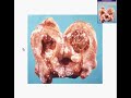 Histopathology Uterus--View 1 Endometrial adenocarcinoma, Vi