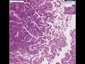 Histopathology Uterus--View 1 Endometrial adenocarcinoma, Vi