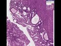 Histopathology Uterus--View 1 Endometrial adenocarcinoma, Vi