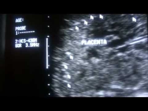 how to locate placenta on ultrasound