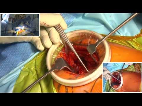 replacement - This video demonstrates a patient undergoing a minimally invasive Total Hip Replacement surgery. It is part of a four part video series that provides a detai...
