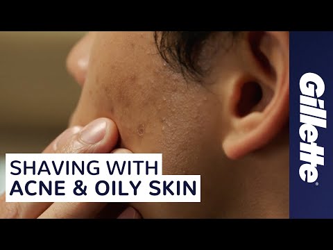 how to a avoid acne