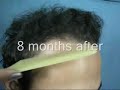 Sean - 3580 FUHT grafts (8 month update) (Hair Transplant)