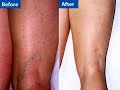 if you're embarrassed about unsightly spider or varicose veins, there are options that can help. let's look at them.