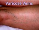 Leg Veins --- Vanished!