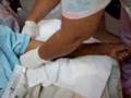 FISTULA