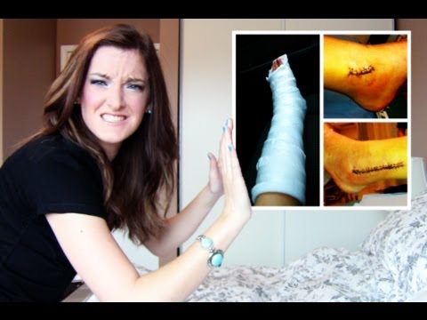 how to break my ankle