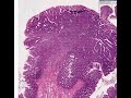 Histopathology Colon --Adenomatous polyp (tubular adenoma) w Histopathology Colon --Adenomatous polyp (tubular adenoma) w