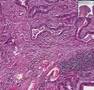 Histopathology Colon --Adenomatous polyp (tubular adenoma) w
