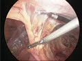 Laparoscopic Ventral Hernia Laparoscopic Ventral Hernia