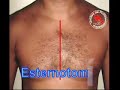 Trauma Cardiaco Penetrante