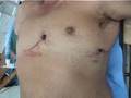 Trauma Cardiaco Penetrante