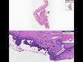 Histopathology Cervix--Squamous cell carcinoma