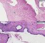 Histopathology Cervix--Squamous cell carcinoma