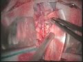 Posterior fossa tumor